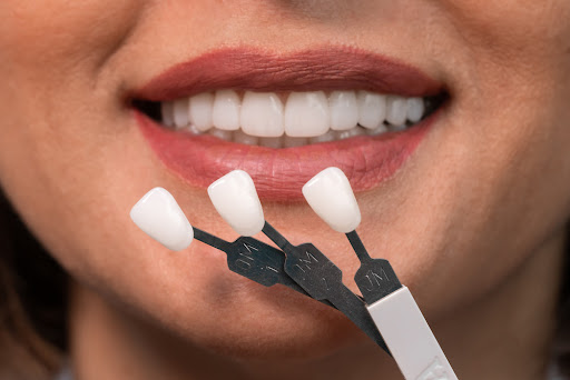 Understanding the Rise of Veneers in Melbourne